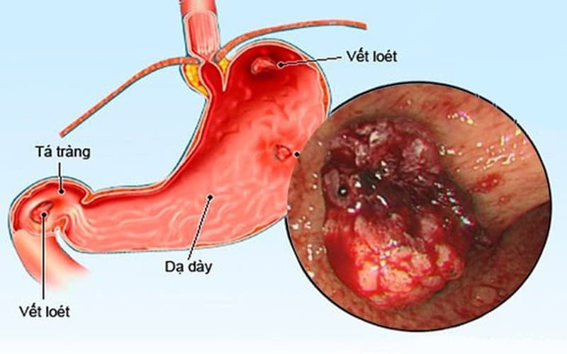 Viêm loét dạ dày có thể gây xuất huyết tiêu hóa