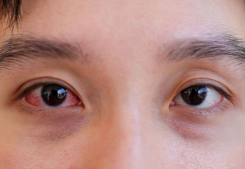 bị đau mắt đỏ một bên thì phải làm sao