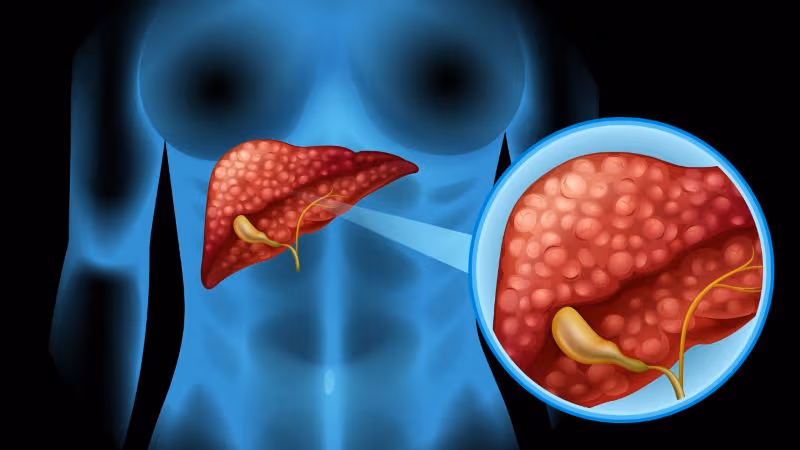 Biến chứng viêm gan B chủ yếu liên quan đến tình trạng nhiễm virus kéo dài và tổn thương gan tiến triển