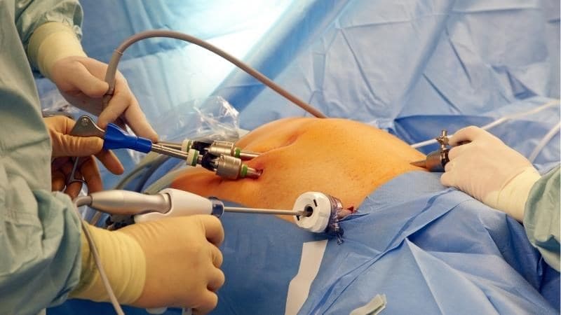 Mổ ruột thừa nội soi là phương pháp thường được lựa chọn để điều trị viêm ruột thừa cấp