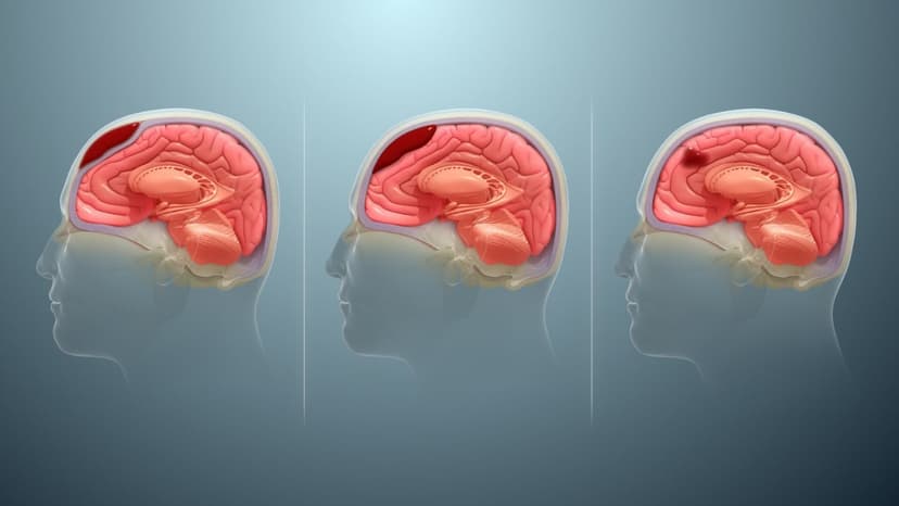 Biến chứng sau mổ tụ máu não thường gặp là gì?