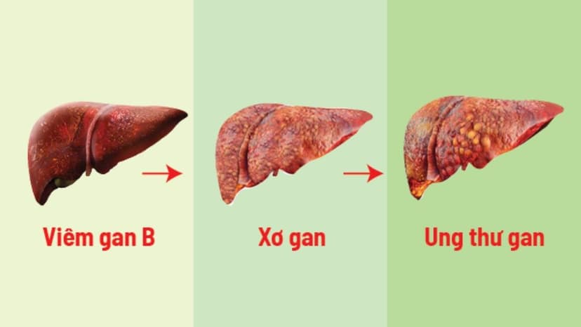 Biến chứng viêm gan B: Những nguy hiểm người bệnh cần cảnh giác
