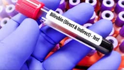 Bilirubin gián tiếp là gì? Chỉ số bao nhiêu là cao?