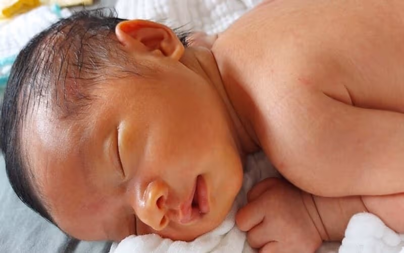 Bilirubin tăng rất phổ biến ở trẻ sơ sinh 
