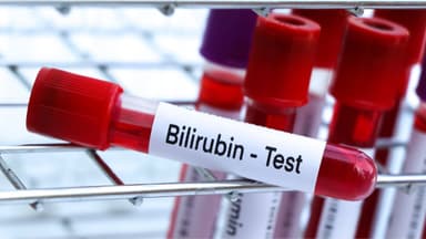 Bilirubin trực tiếp là gì? Chỉ số bao nhiêu là cao?