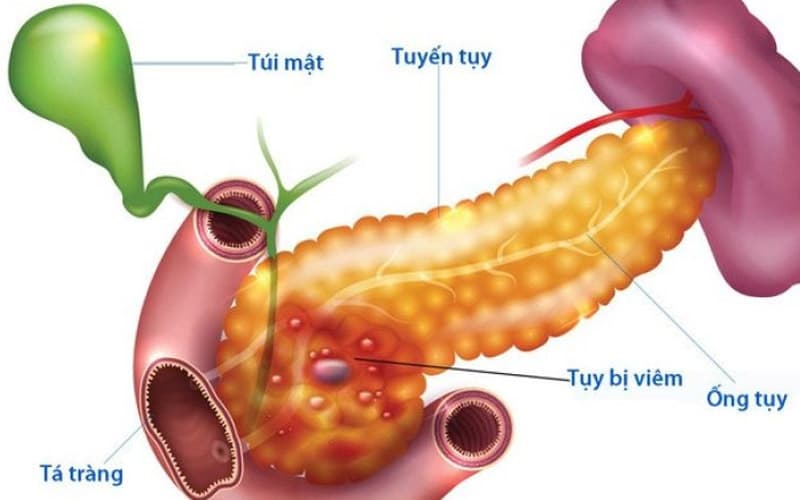 Viêm tụy cấp là bệnh lý thường gặp nhất ở tuyến tụy