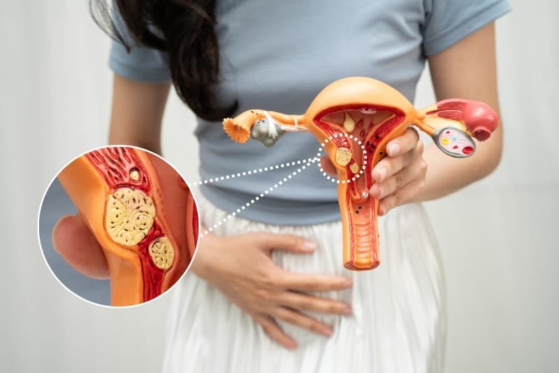 Không phải lúc nào khối u xơ cũng gây ra những dấu hiệu nhận biết rõ ràng cho người bệnh trong giai đoạn đầu