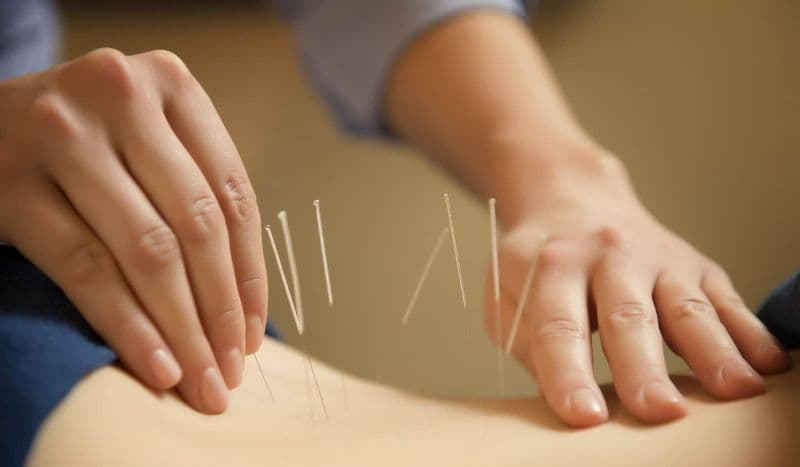 Châm cứu là một trong những phương pháp phổ biến trong Y học cổ truyền 