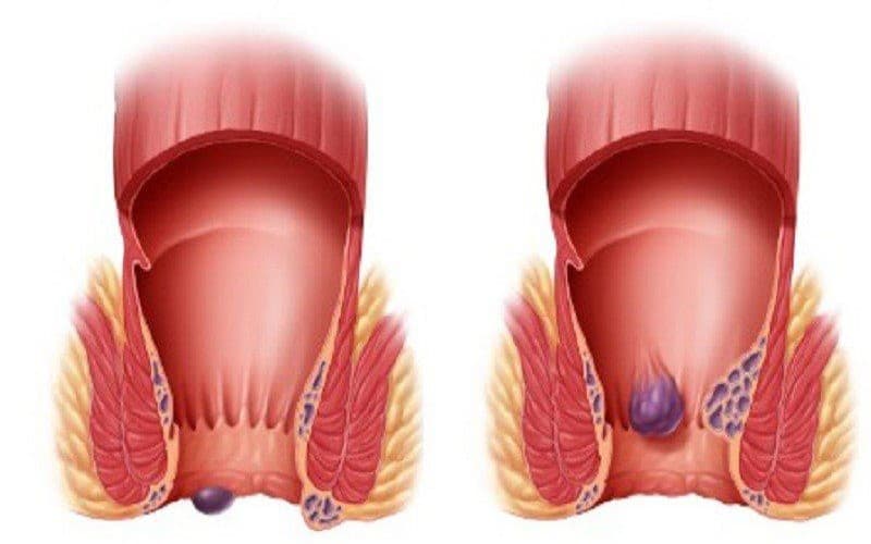 Chẩn đoán lòi dom để đánh giá mức độ bệnh