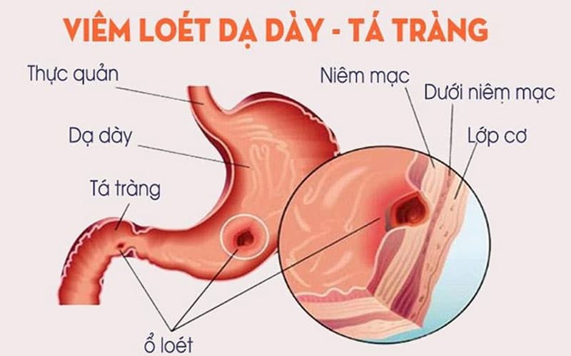 Đau dạ dày là dấu hiệu thường gặp của tình trạng viêm loét dạ dày