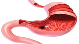 Đau dạ dày mãn tính nguy hiểm không?