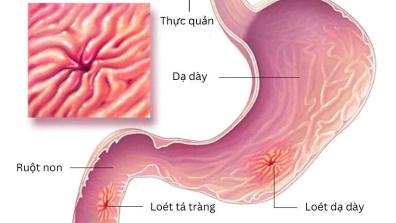 Dạ dày tá tràng là gì? Cấu tạo, chức năng, bệnh lý thường gặp và cách phòng ngừa thế nào?