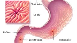 Dạ dày tá tràng là gì? Cấu tạo, chức năng, bệnh lý thường gặp và cách phòng ngừa thế nào?