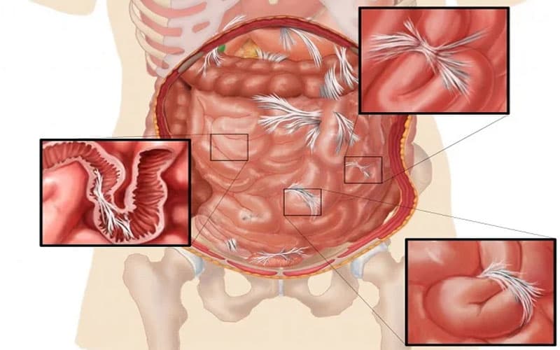 Dải dính ruột sau phẫu thuật có thể gây tắc ruột