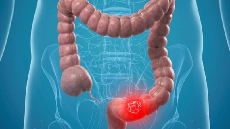 Chưa xác định được một nguyên nhân duy nhất gây bệnh Crohn ở trẻ em
