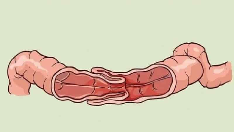 Lồng ruột khiến một đoạn ruột chui vào đoạn ruột kế cận, gây cản trở lưu thông trong lòng ruột