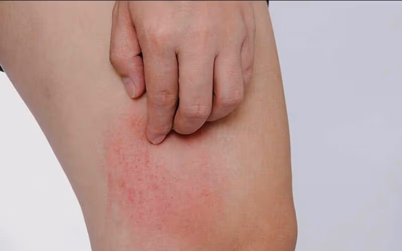 Chú ý các dấu hiệu gợi ý ngứa do bệnh gan