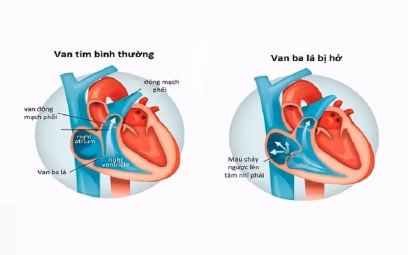 Hở van ba lá có thể làm tăng áp lực nhĩ phải và tĩnh mạch cổ