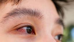 Đau mắt đỏ một bên có nguy hiểm không?