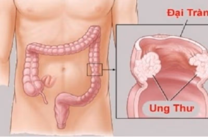 Điều trị đích trong ung thư đại tràng là phương pháp được chỉ định ở một số người bệnh dựa trên giai đoạn bệnh