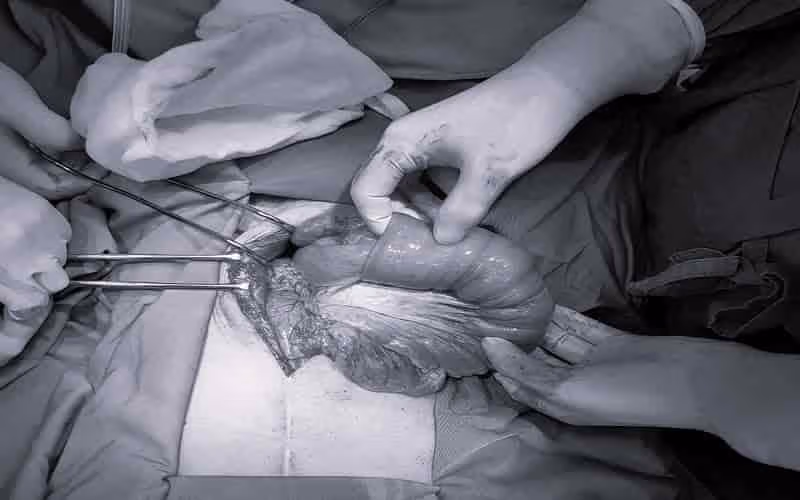 Phẫu thuật điều trị lồng ruột ở người lớn