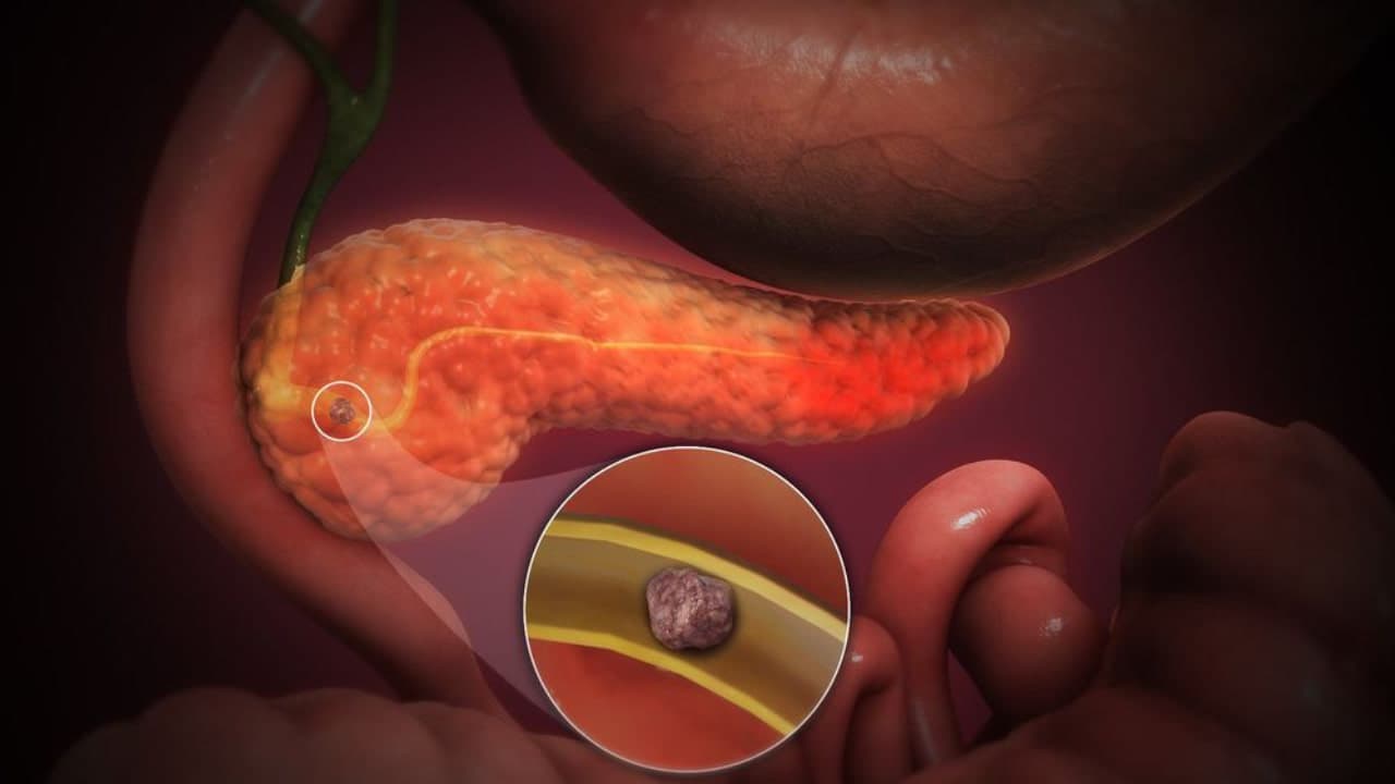 Điều trị sỏi tụy: Phương pháp hiệu quả và những điều cần lưu ý