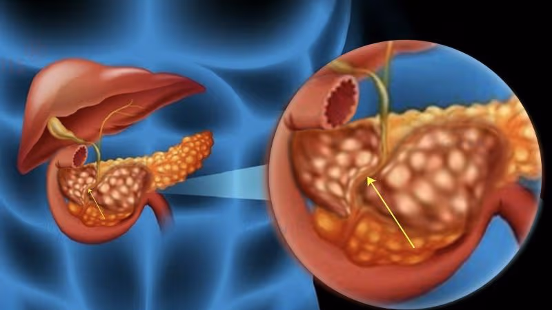 Điều trị tắc mật trong gan cần dựa vào nguyên nhân, vị trí và mức độ tắc nghẽn