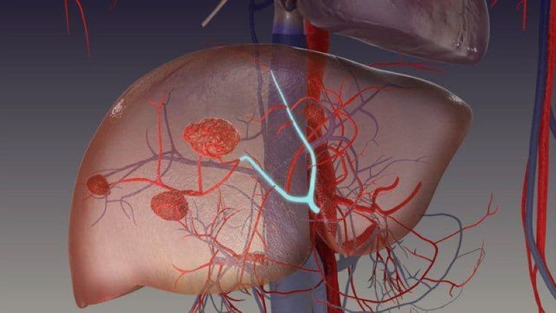Không phải cứ phát hiện hemangioma là phải điều trị