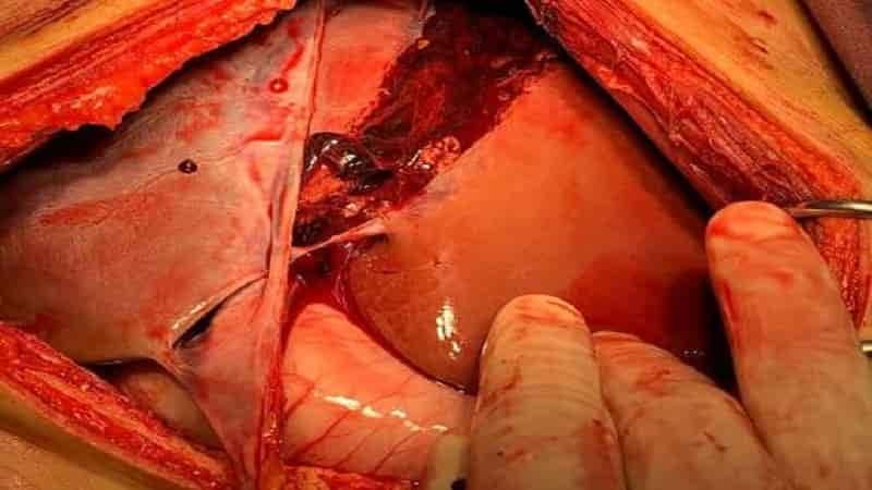 Phẫu thuật vỡ gan là phương pháp ngoại khoa cấp cứu