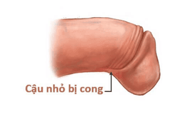 Dương vật cong xuống có quan hệ được không?