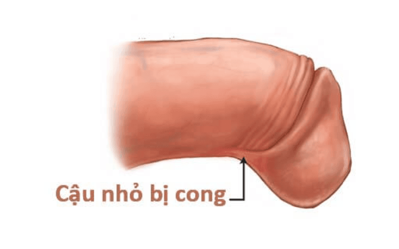 Dương vật cong xuống có quan hệ được không?