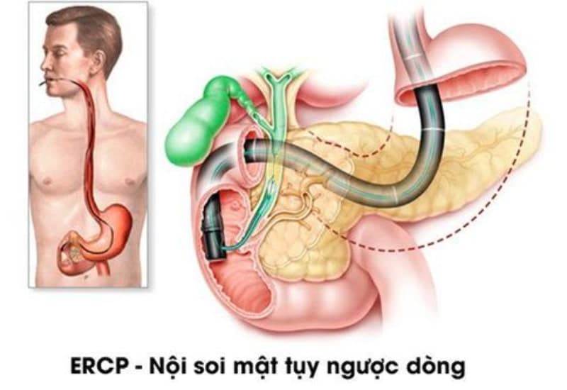 Phương pháp ERCP nội soi lấy sỏi tụy