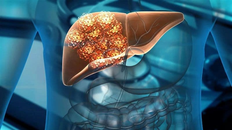 Gan yếu có thể liên quan đến nhiều nguyên nhân như gan nhiễm mỡ, uống rượu bia hoặc viêm gan virus