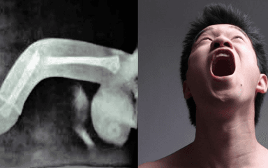 Gãy dương vật khi quan hệ xảy ra như thế nào?
