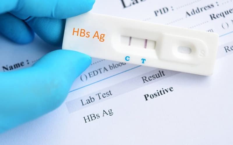 HbsAg dương tính báo hiệu bạn đã bị nhiễm virus viêm gan B