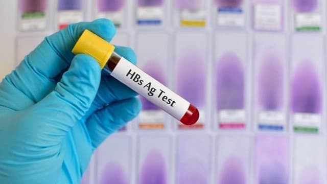 Xét nghiệm HbsAg là gì? Cần làm gì khi xét nghiệm HbsAg dương tính?