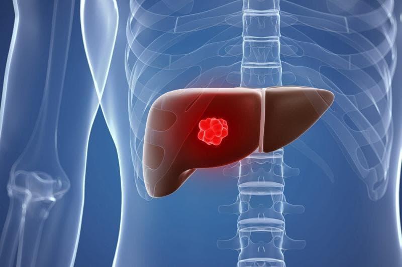 Phần lớn hemangioma gan không gây triệu chứng