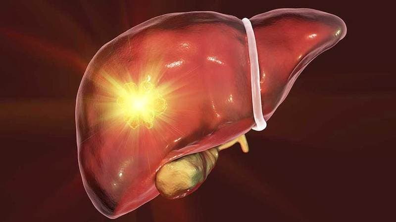 U máu gan là tổn thương lành tính và phần lớn trường hợp không nguy hiểm