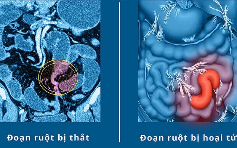 Tắc ruột quai kín trong thời gian dài có thể gây hoại tử đoạn ruột
