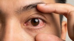 Làm sao để hết đỏ mắt nhanh nhất? Khi nào cần đi khám?