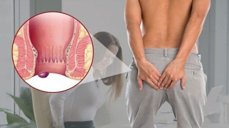 Lòi dom là cách gọi dân gian thường được dùng để chỉ bệnh trĩ, đặc biệt khi búi trĩ sa ra ngoài hậu môn
