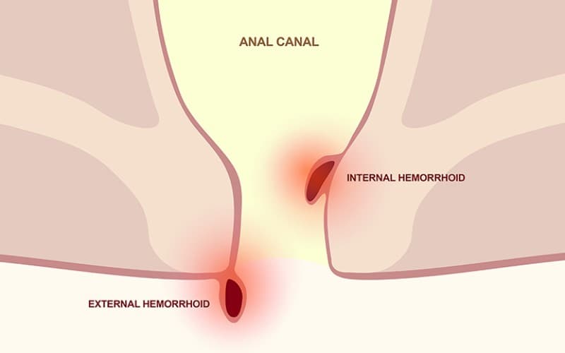 Bệnh lòi dom là tình trạng búi trĩ sa ra ngoài hậu môn