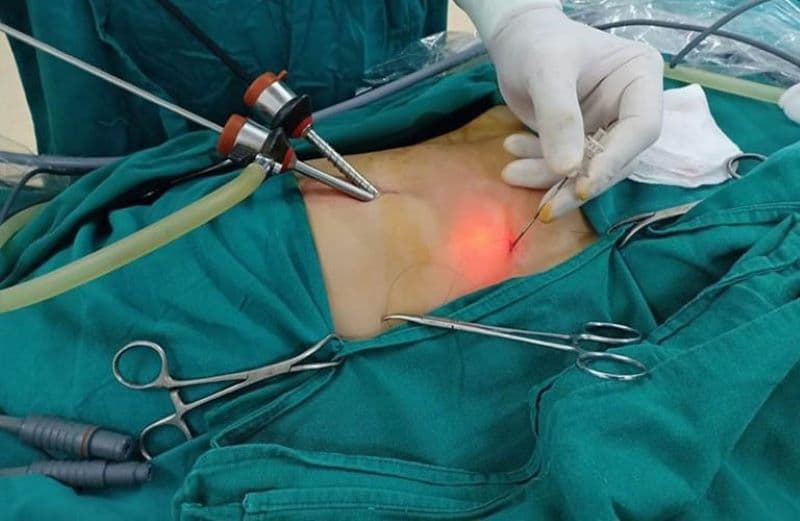 Khi sỏi gây đau, viêm hoặc làm tắc đường mật, bác sĩ có thể chỉ định mổ nội soi sỏi mật