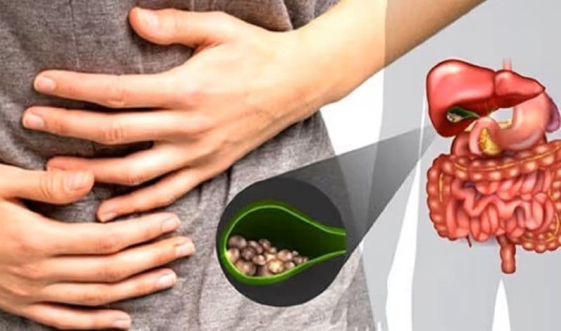 Mổ nội soi sỏi mật là phương pháp điều trị phổ biến và tương đối an toàn khi được thực hiện đúng chỉ định