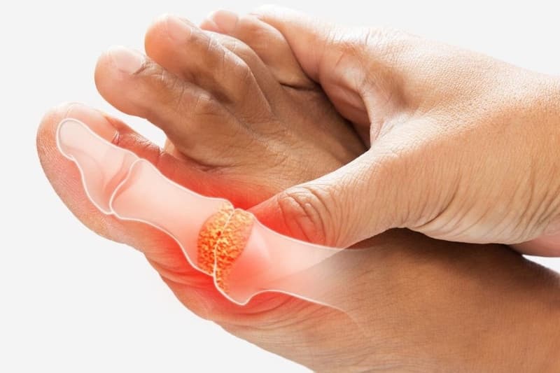 Khi bệnh đang bùng phát với biểu hiện khớp sưng, nóng, đỏ và đau dữ dội, người bệnh cần kiểm soát cơn gút theo hướng dẫn của bác sĩ