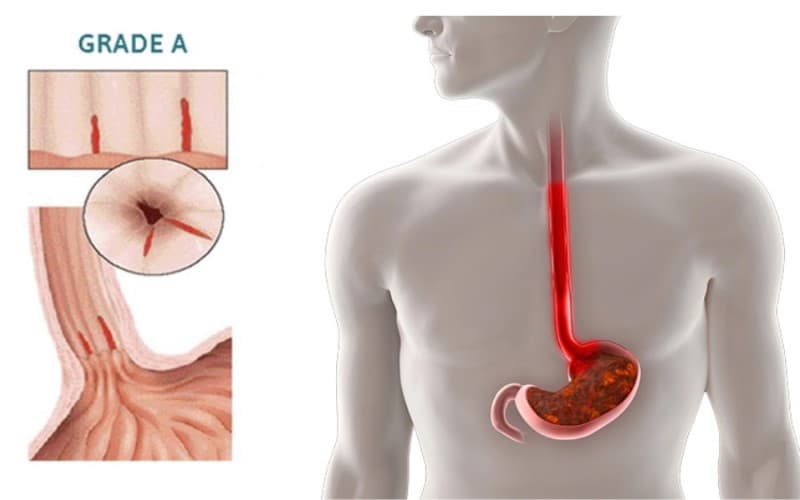 Nguyên nhân người bị dạ dày dễ bị trào ngược