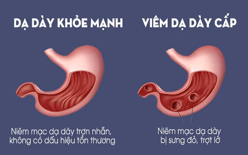 Sự khác biệt giữa dạ dày bình thường và dạ dày bị viêm cấp