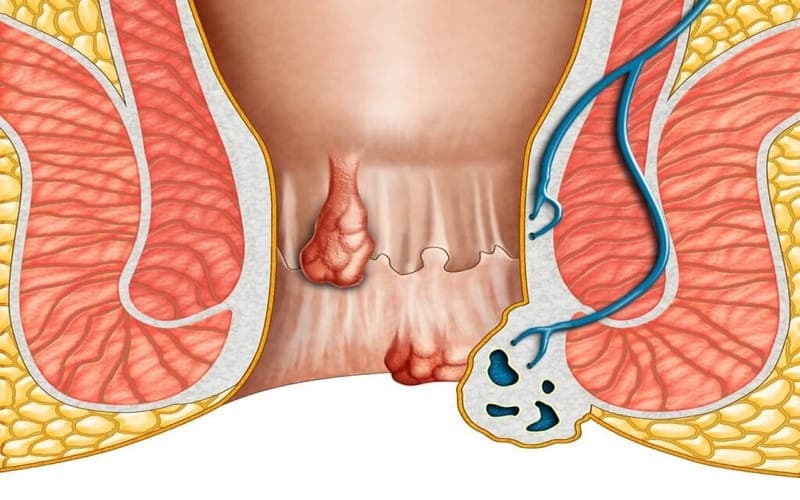 Có nhiều nguyên nhân gây bệnh lòi dom