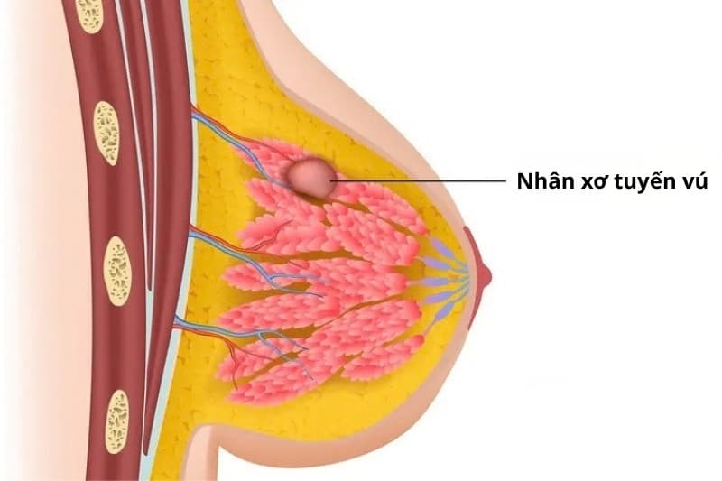 Khối u xơ vú thường không biến đổi kích thước quá nhanh