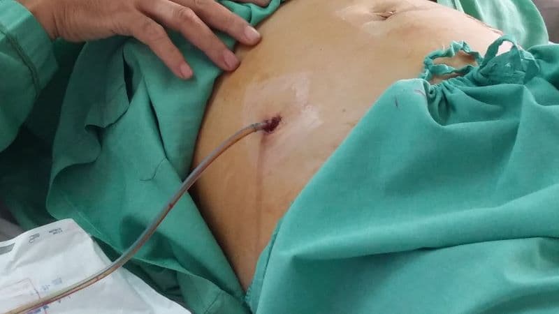Biến chứng sau mổ ruột thừa nội soi không phải lúc nào cũng xảy ra